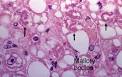 <b>ALCOHOLIC HEPATITIS</b> Mallory