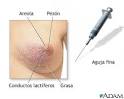 <b>Biopsia</b> de mama femenina:
