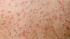 BBC News - MEASLES: 64 new cases in south west Wales outbreak