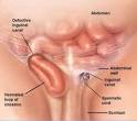 from <b>inguinal hernia</b>,