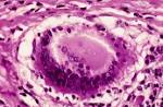 <b>thyroiditis</b>, <b>subacute</b>
