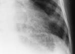 Clinical and Radiographic Findings in Pediatric Mycoplasma <b>Pneumonia</b> 1