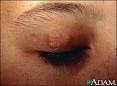 <b>Eyelid</b> Skin <b>Problems</b> -