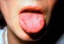 Aphthous <b>stomatitis</b>