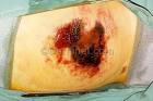 <b>Ecthyma</b> Gangrenosum Photo - Skin Disease Pictures