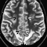 Irreversible <b>hypertensive</b>