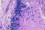 <b>Ganglioneuroblastoma</b>