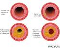 Ischemic Stroke