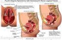 Recto-<b>vaginal Fistula</b>