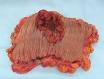 <b>Neoplasm</b> - Wikipedia, the free encyclopedia