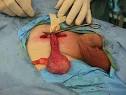 The TCRC Orchiectomy Page