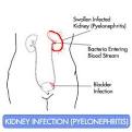 Signs of a Kidney Infection in Women | Ask Dr. Sarah - The Health ...