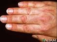 Dermatomyositis - Physiopedia, universal access to physiotherapy ...