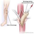 Endarterectomy
