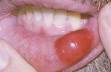 idiopathic thrombocytopenic purpura - definition of idiopathic ...