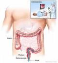 CA | CT <b>Colonoscopy</b>