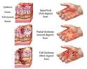 Clinical Trials and New Treatments for the Burn