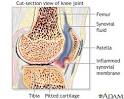 <b>Rheumatoid arthritis</b> is