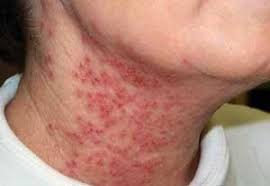 shingles virus