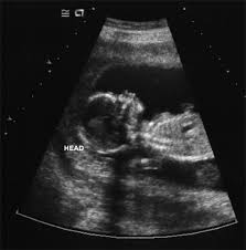 ultrasound at 16 weeks