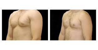 gynecomastia