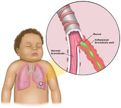 ما هو التهاب الشعيبات الهوائية؟ وكيف يحدث؟ Bronchiolitis_anatomy