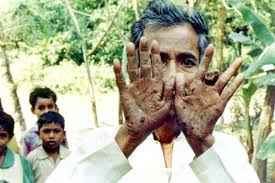 Health impacts of arsenic in