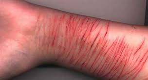 cutting yourself