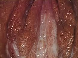 Gonorrhea