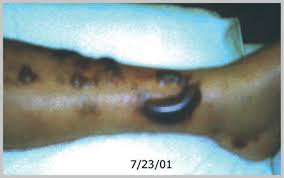 Leg with septicemia
