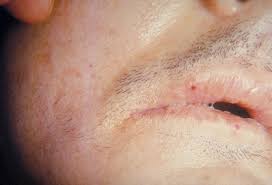 Staph Infection - Septicemia