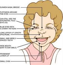 Williams Syndrome (also named