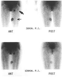 adenopatia inguinal