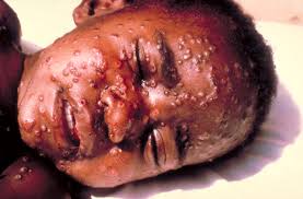 CDC Smallpox | Smallpox
