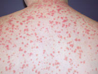 What is psoriasis?