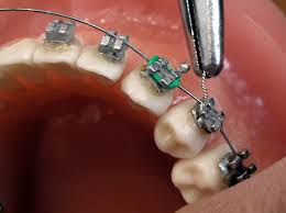Brackets06 Brackets   Aparato dental