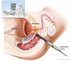 prostate check