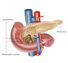 pancreatic cancer cures may