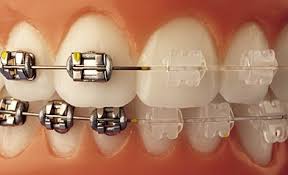  Alinear los dientes