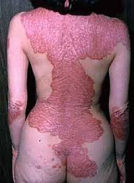 Further, psoriasis causes
