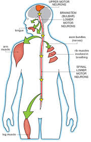 ALS, Lou Gehrigs Disease