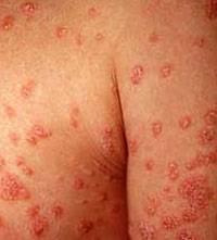 Psoriasis Pictures: Diagnose