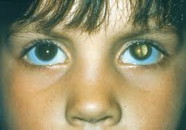 الماء الأبيض للعين cataract Kid%2520with%2520cataract