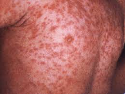 Measles Outbreak Spreads to 15