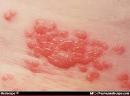 shingles virus