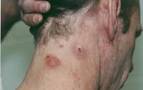 More pics of staph infections