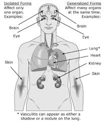 Kawasaki Disease