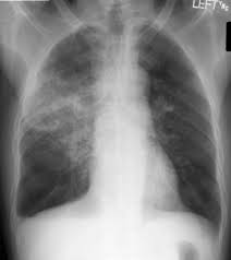 pneumonia