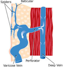 سبع غرائب بأجسامنا Varicose_vein_e