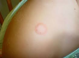 Ringworm